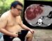 ສັງເກດທ້ອງຕົນເອງເບິ່ງ ວ່າເປັນ “ໂລກຕຸ້ຍ” ຫຼື “ມະເຮັງຕັບ”